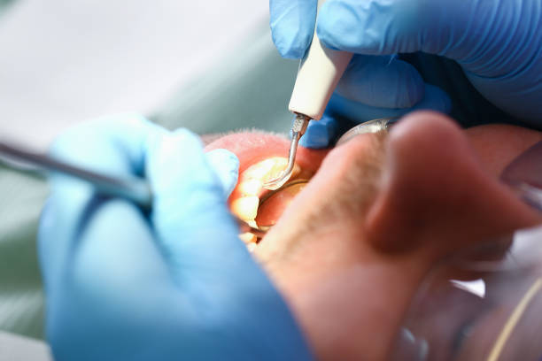 Best Emergency Treatment for Dental Infections or Abscesses in Norton, OH
